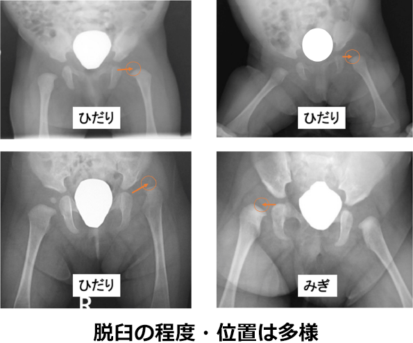 脱臼の程度・位置は多様