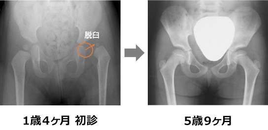 徒手整復