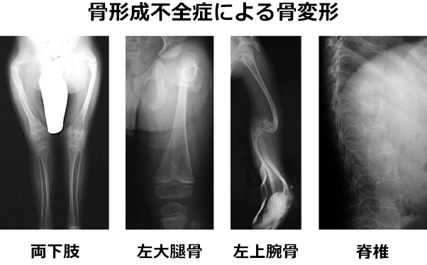 骨形成不全症による骨変形